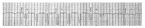 Obr. 15: Záznam segmentu prvního magnetografického měření ze dne 22. 6. 1972 v Ondřejově.  Na záznamu z registračního zapisovače vidíme průběh jasu v oblasti sluneční skvrny.  Skvrna se nacházela na konci řádku, skanování skvrny probíhalo po řádcích střídavě zprava a zleva. Proto na registraci vidíme dva poklesy jasu těsně vedle sebe. Mapy magnetických polí se z registrací musely vykreslovat ručně, protože digitální technika nebyla tenkrát ještě k dispozici.